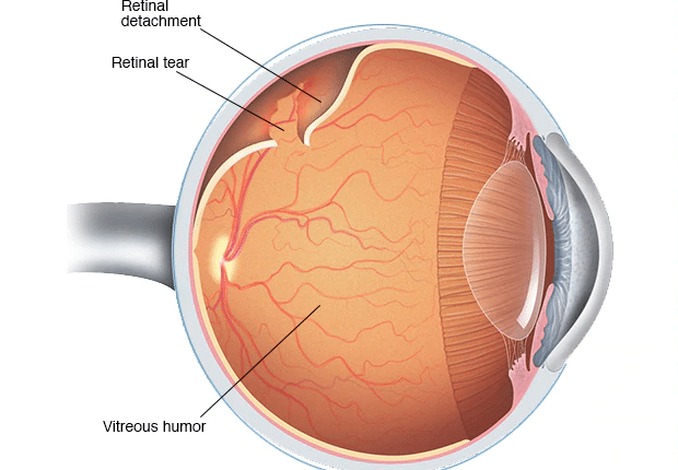 Retina-dekolmanı